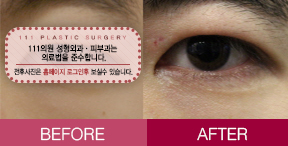 눈전후포멧12.jpg