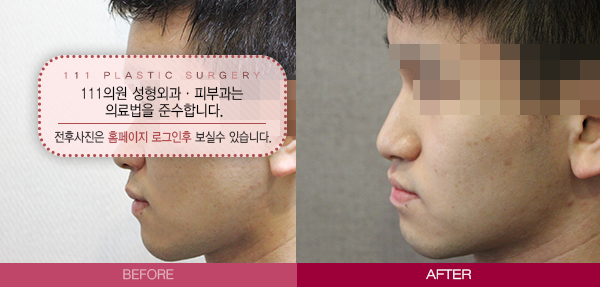 코필러_3.jpg